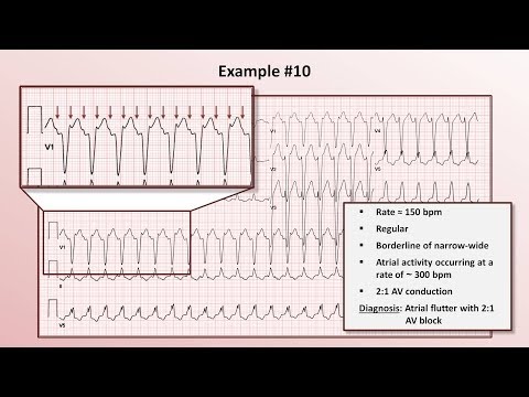 Intro to EKG Interpretation - Practicing Tachyarrhythmia Identification
