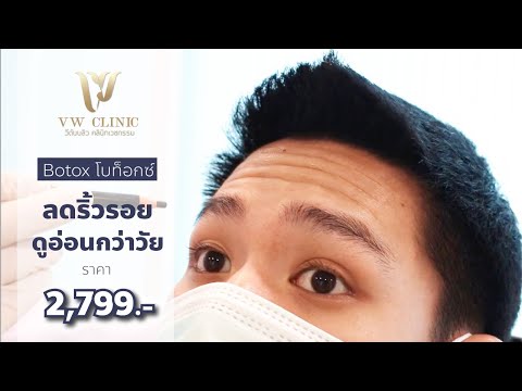 ฺBotox ริ้วรอย