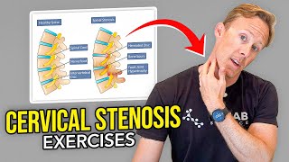 5 Exercises for Cervical Stenosis (Arm Nerve Pain)