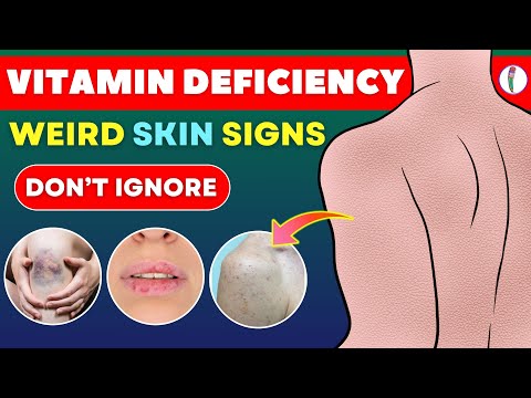 10 Shocking Skin Signs of Vitamin Deficiency You Need to Know