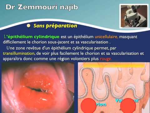 îndepărtarea verucilor genitale din colul uterin recenzii