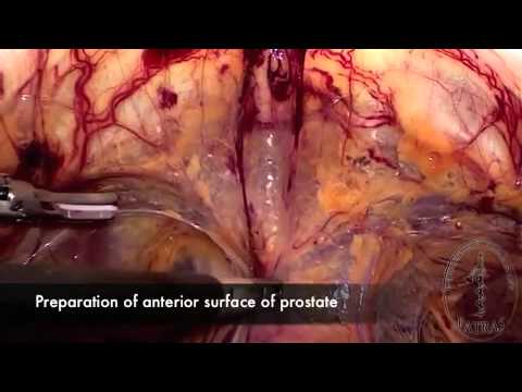 Laparoscopic Radical Prostatectomy - Dissecting the Anterior Surface