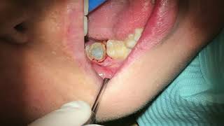 Pus from Infected Wisdom Tooth