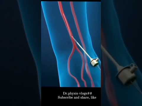 #Heart blockage treatment.....