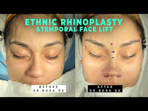 Scarless Face Lift, Brow Lift With Closed Ethnic Rhinoplasty by Dr. Bora Ok, Istanbul Turkey
