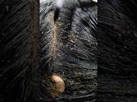 Nits lice treatment 100% result within 2 hrs Chennai #headliceremoval#liceremoval#nits#lice#headlice