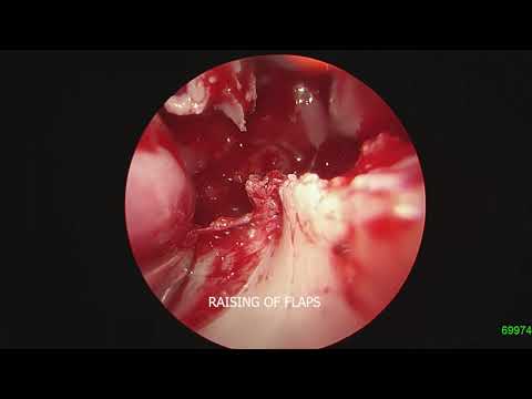 ENDOSCOPIC ENDONASAL CRANIOVERTEBRAL JUNCTION DECOMPRESSION