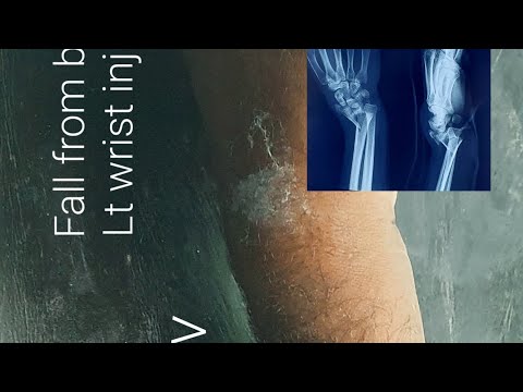 Communited fracture Lower end Radius | Wrist bone fractures | Closed reduction, K-wiring | Adamya HV