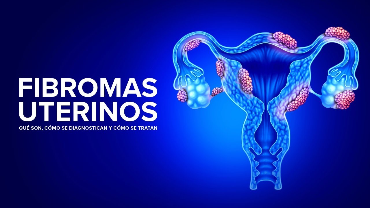 Thumbnail preview of Fibromas Uterinos - Qué son, cómo se diagnostican y cómo se tratan