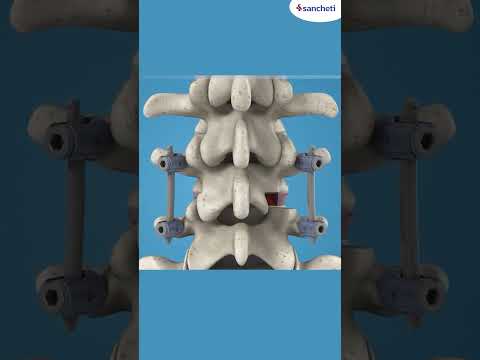 MIS TLIF Technique Cures Patient | मरीज़ की रीढ़ की सर्जरी सफल - MIS TLIF तकनीक से इलाज