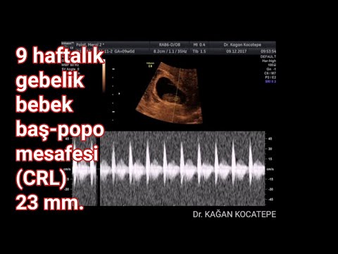 9 haftalık (2 aylık) gebelik - bebeğin kalp atışları görülüyor. CRL (baş-popo mesafesi) 23 milimetre