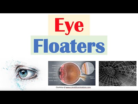 Eye Floaters (Vitreous Floaters) | Causes, Risk Factors, Associated Conditions, Diagnosis, Treatment