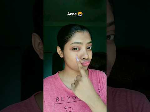 36 pcs acne patch pimple patch