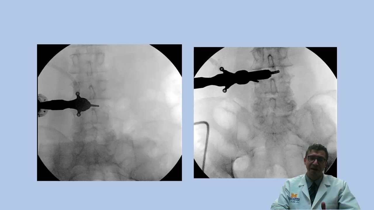 CNS Neurosurgery 100: Introduction to Spine Endoscopy