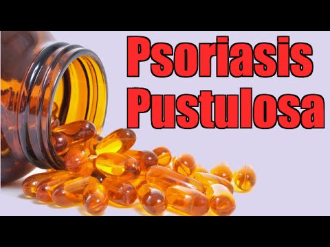 Piobakteriofag e dermatite atopic Cura di psoriasi al bambino