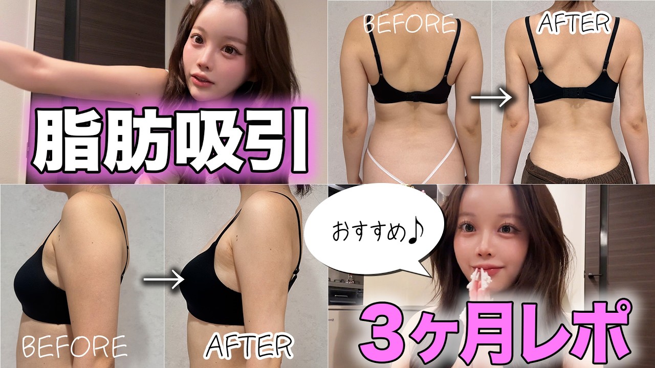 【脂肪吸引レポ】絶対に痩せない「二の腕・背中」のお肉とお別れ！大激変のDT30日間Vlog。