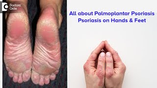 All about Palmoplantar Psoriasis | Psoriasis on hands & feet - Dr. Rajdeep Mysore | Doctors