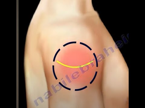 Deltoid muscle injection  - Axillary nerve, Deltoid muscle anatomy.