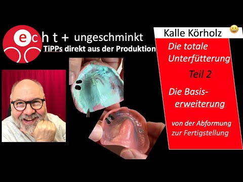 Unterfütterung/Basiserweiterung  -  2. Teil mit einer Teleskop-Prothese