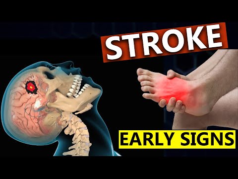 Top Warning Signs of Stroke One Month Before Disaster - Shocking Symptoms Revealed!