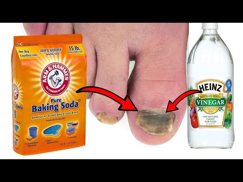 How To Get Rid of TOENAIL FUNGUS With Baking Soda & Vinegar
