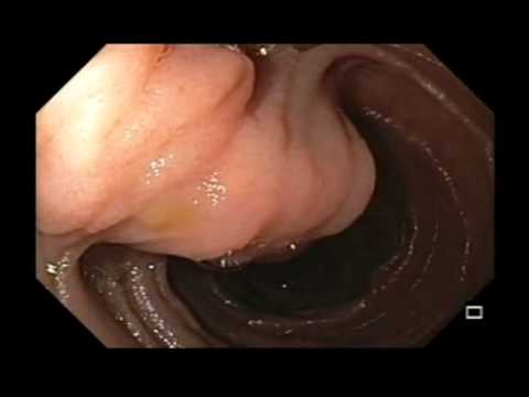 Intestino delgado, tumor benigno, reposo pancreático con NMPI