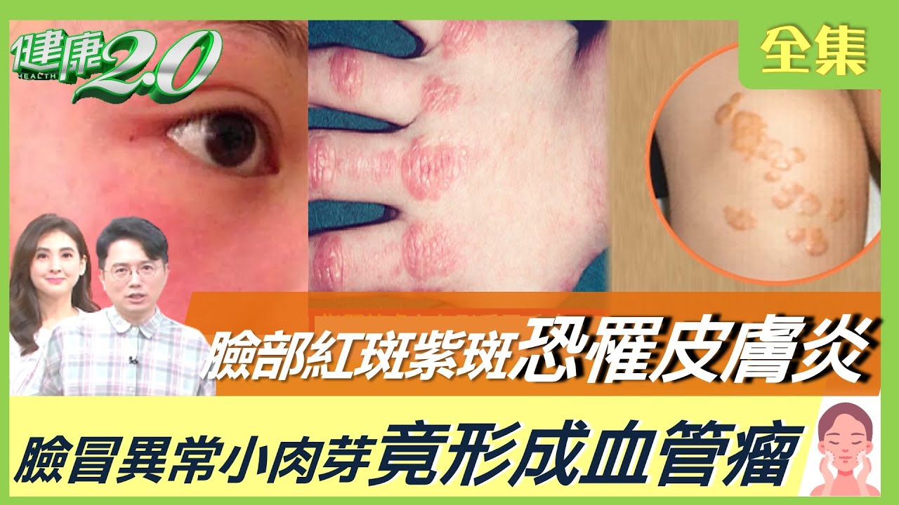 小肉芽恐是脂肪瘤!4狀況要切除 中醫推「這招」恢復皮膚光滑