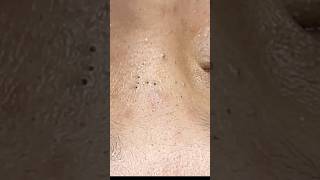 Blackheads Hidden Between the Eyes – Satisfying Extraction #shorts  #shortvideo #blackheads #acne