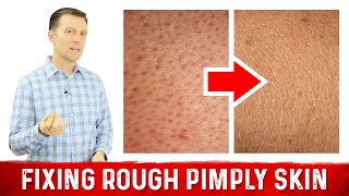 What Does Rough Pimply Skin (Chicken Skin or KERATOSIS PILARIS) Mean? – Dr. Berg