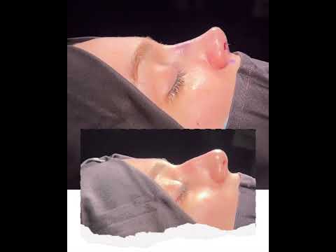 Op. Dr. Ayşe Karakaya | Eskişehir Rhinoplasty | #Rhinoplasty #NoseAesthetics #Discover #HealthTourism