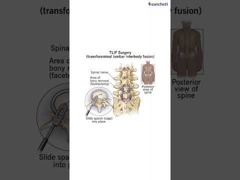 MIS TLIF Successful Surgery | Dr. Ajay Kothari