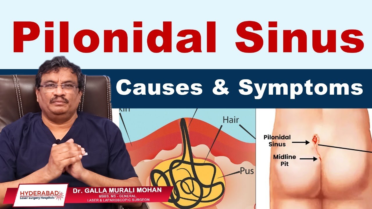 Piles Laser Treatment Video 7