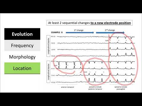 Clinical and Electrographic Seizures