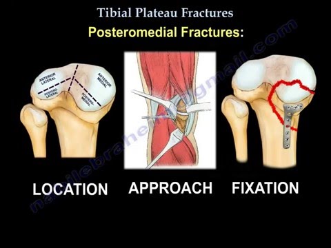 Tibial Plateau Fractures - Everything You Need To Know - Dr. Nabil Ebraheim