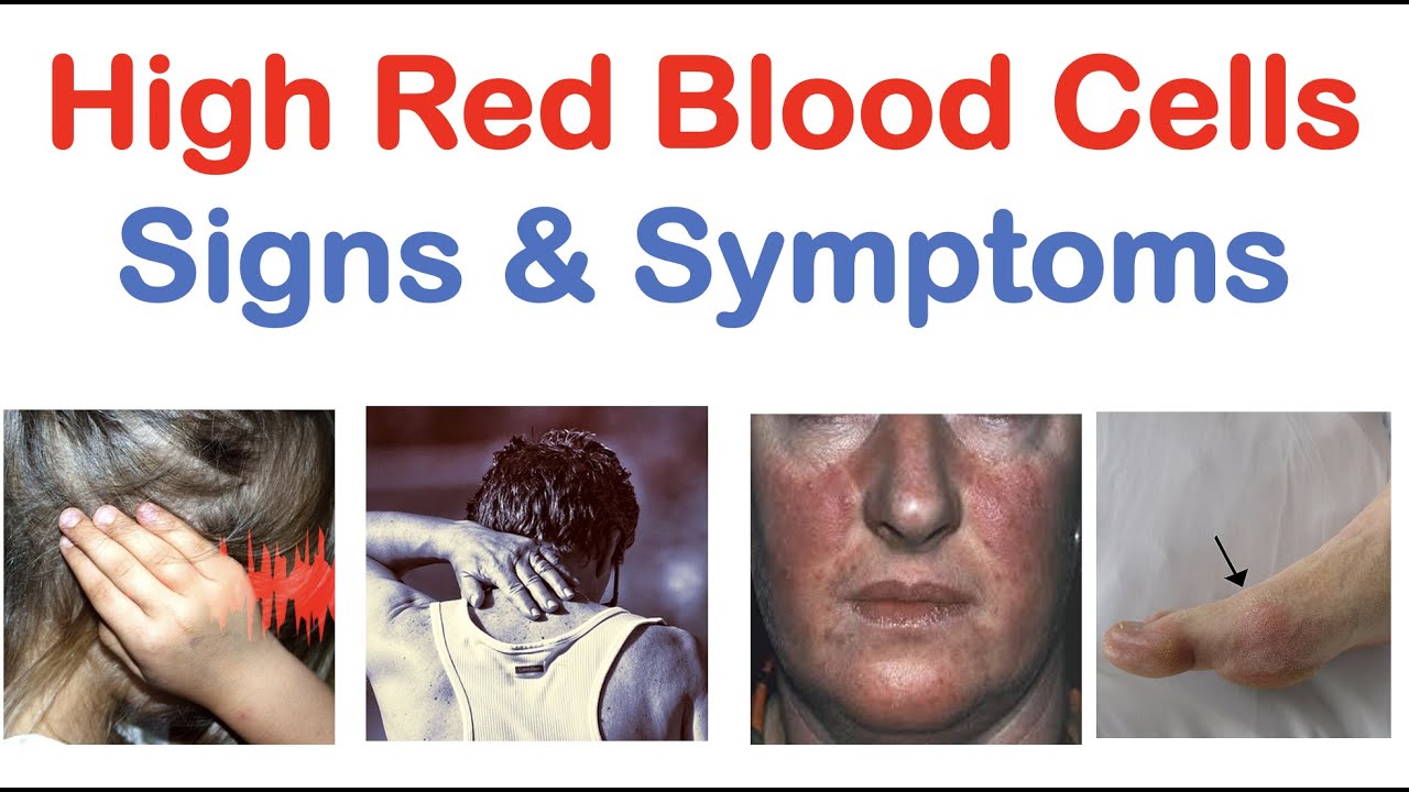 High Red Blood Cells (Polycythemia) Signs & Symptoms (& Why They Occur)
