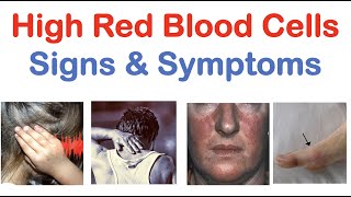 High Red Blood Cells (Polycythemia) Signs & Symptoms (& Why They Occur)