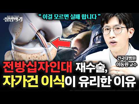 헬스조선 - '이걸' 모르면 수술 실패 합니다! 전방십자인대 재수술, 자가건 이식이 유리한 이유는?