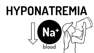 HYPONATREMIA made easy!!