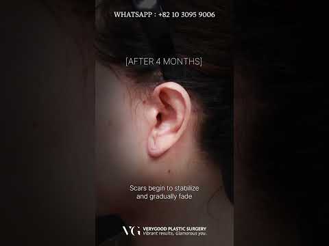 Complete Guide to the Facelift Scar Healing Process in Seoul South Korea