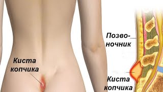 Պոչուկի կիստան՝ ի ծնե խնդիր. լինու՞մ է այն վերացնել