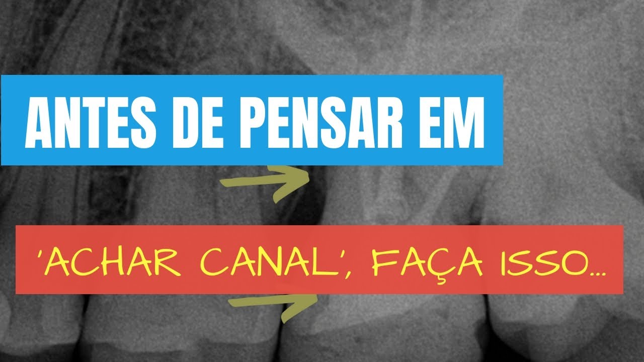 PULAR ESSES DOIS PASSOS NA ABERTURA PODE COMPROMETER O SUCESSO DO TRATAMENTO! - QUICK TIP ENDOLOVERS