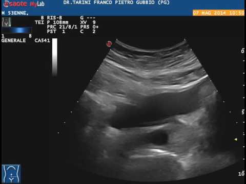 Utilizzare di SDA-2 in adenoma prostatico Massaggio prostatico maschile Strap Video