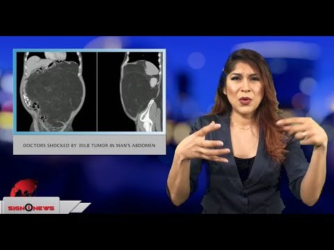 Doctors shocked by 30lb tumor in man’s abdomen (ASL - 4.2.18)