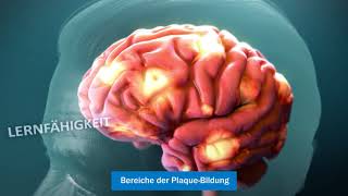 Die Alzheimer-Krankheit verstehen (Understanding Alzheimer’s Disease)