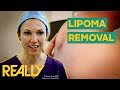 Dr Emma Removes An Abnormally Large Lipoma From A Patient S Back The Bad Skin Clinic