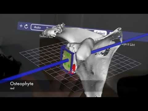 Mixed Reality Planning Anatomical Total Shoulder Arthroplasty