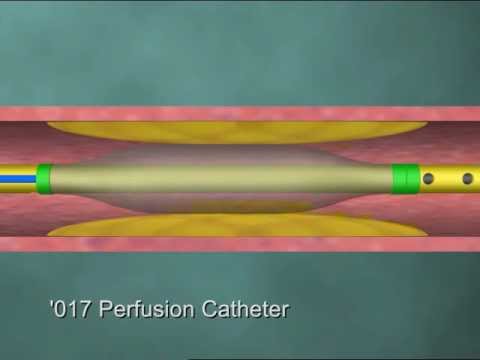 Image of Medical Videos: Perfusion Catheter
