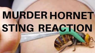 Stung By GIANT Murderous Hornet  (STINGER GETS STUCK)