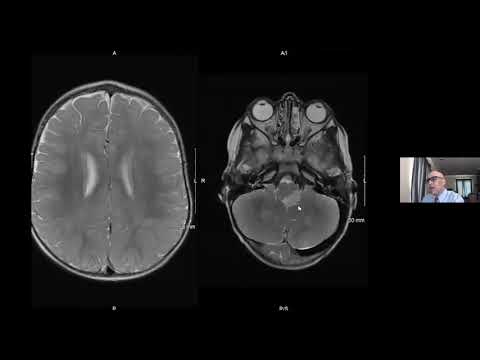 Neurocutaneous Syndromes - Developing Brainstem Lesion - Subtle Optic Glioma