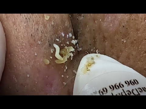 Blackhead removal up close by the dozens.